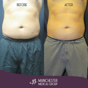 steve-sculpsure-before-after-1