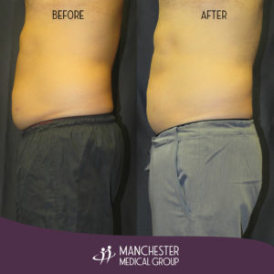 steve-sculpsure-before-after-2