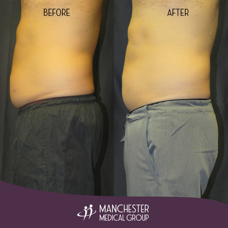 stevesculpsurebeforeafter2 Manchester Medical Group